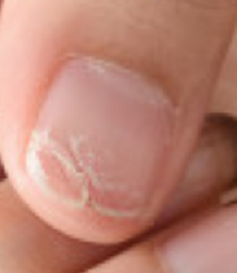gescheurde nagel - gespleten nagel - broze nagels - splijtende nagels -